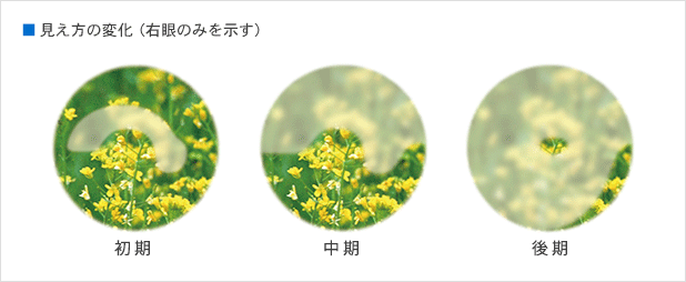 緑内障による見え方の変化(初期・中期・後期の視野の進行)