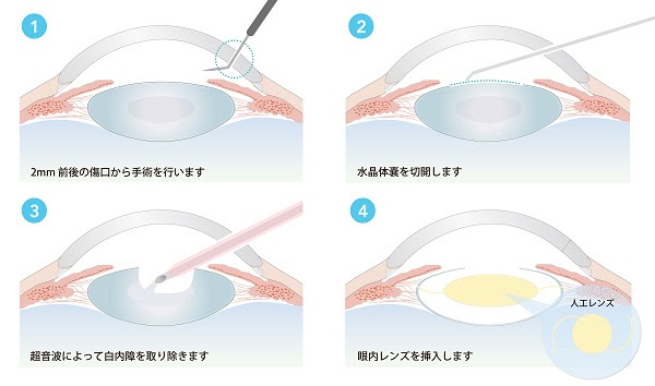 白内障手術の流れ（2.4ミリ切開→水晶体嚢の切開→超音波吸引→眼内レンズ挿入）