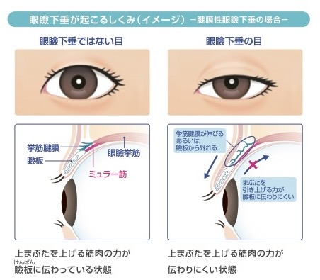 眼瞼下垂とは