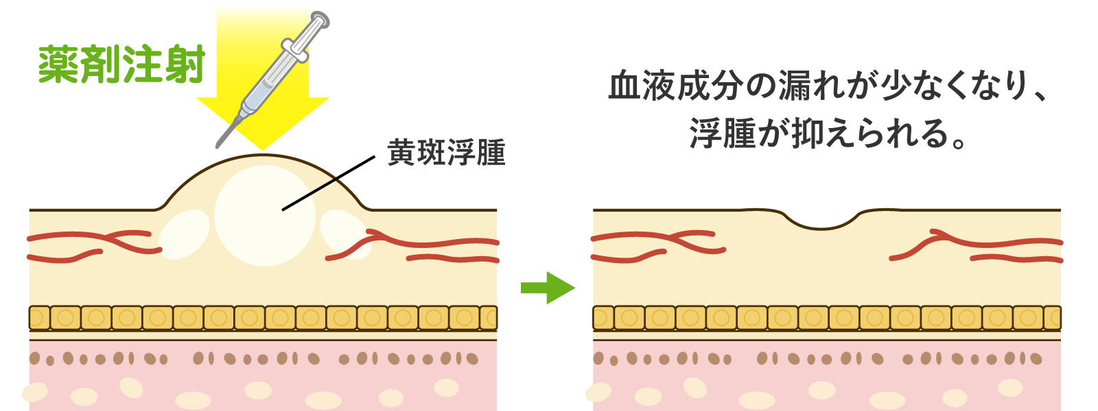 硝子体注射（抗VEGF薬）とは