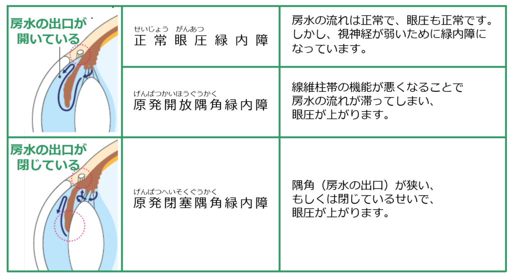 緑内障の分類(開放隅角緑内障・閉塞隅角緑内障の違い)