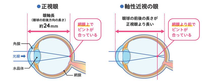 近視とは