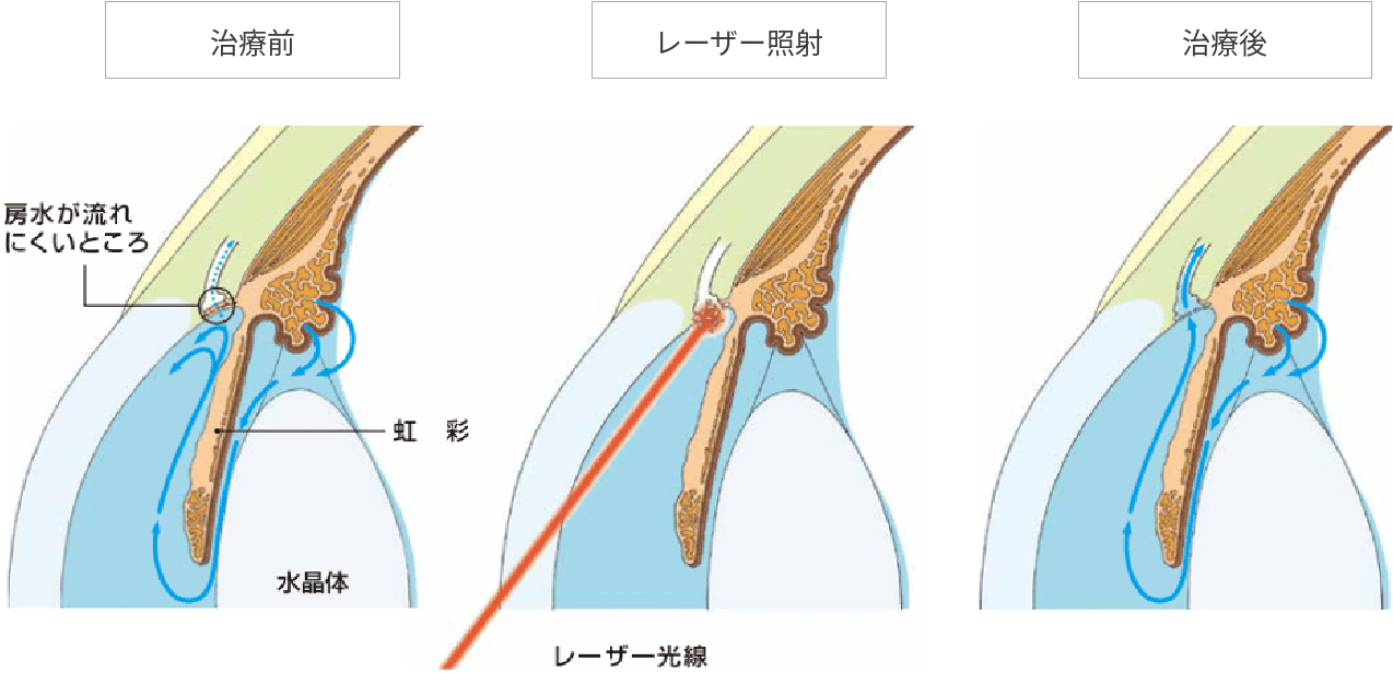 SLTのしくみ（治療前：線維柱帯の目詰まり／レーザー照射／治療後：房水の流れが改善）